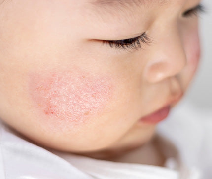 Close-up of a child's face with redness and atopic patch of skin on the cheek.