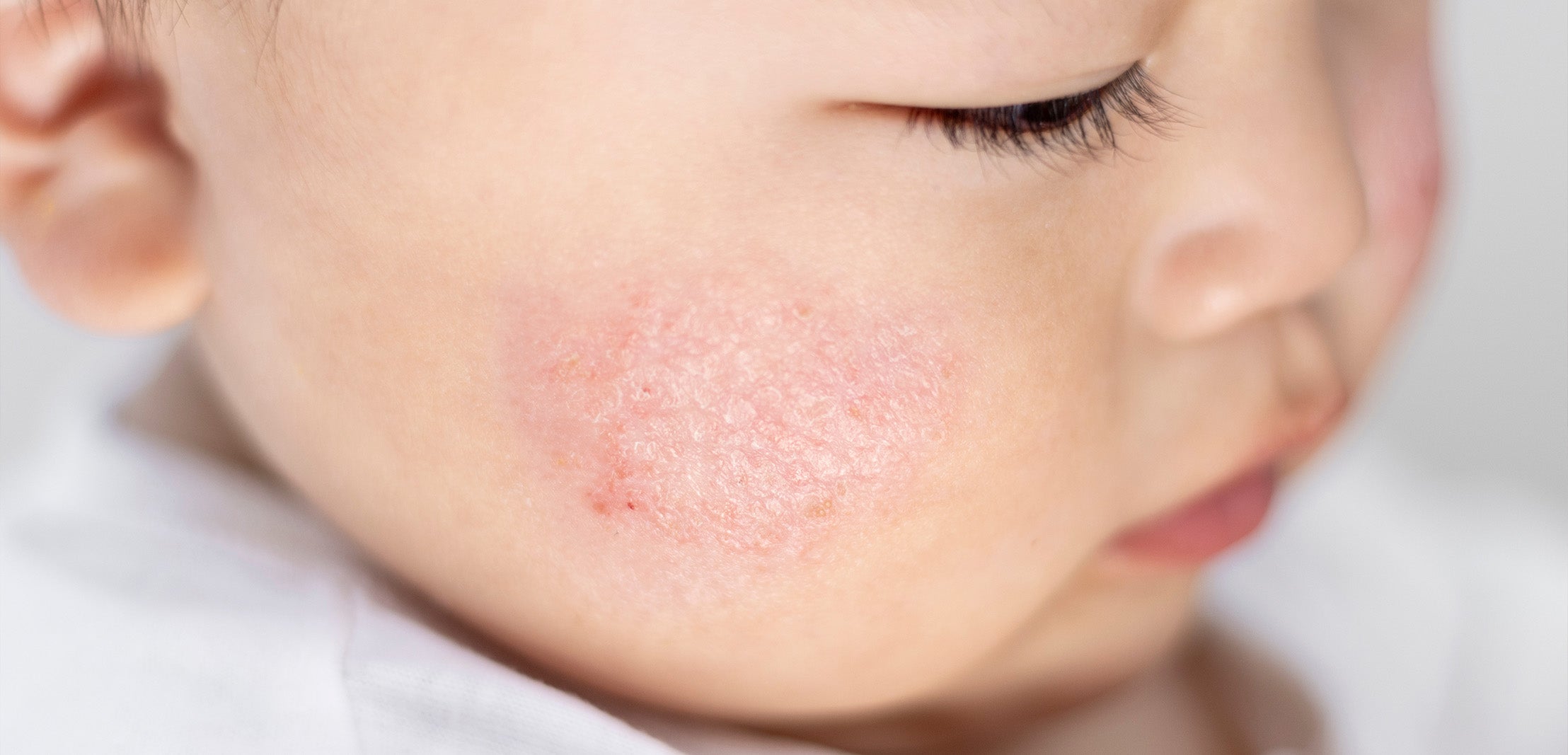 Close-up of a child's face with redness and atopic patch of skin on the cheek.