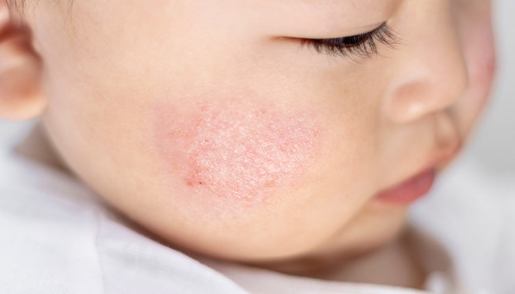 Close-up of a child's face with redness and atopic patch of skin on the cheek.