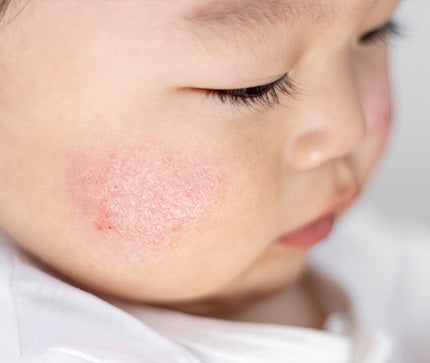 Close-up of a child's face with redness and atopic patch of skin on the cheek.